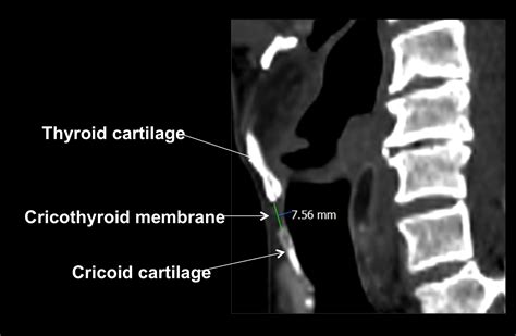 The Height Of The Cricothyroid Membrane On Computed Tomography Scans In