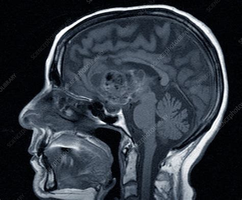 Astrocytoma Brain Cancer Mri Scan Stock Image C0370759 Science