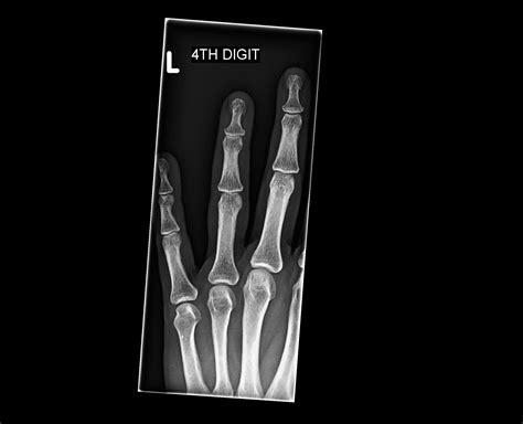 Orthodx Mallet Finger Clinical Advisor