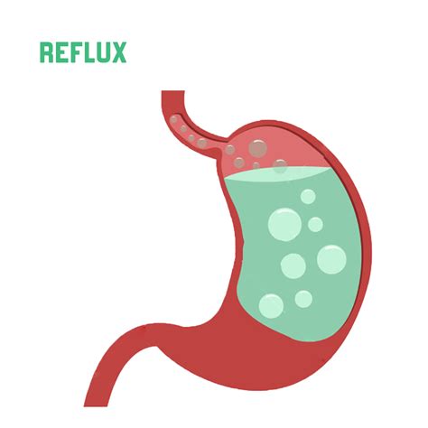 Symptoms And Treatment For Reflux In Singanallur Coimbatore