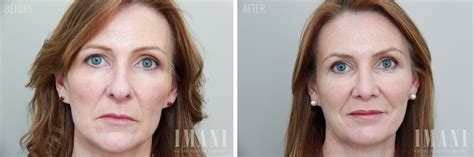 Facial Rejuvenation Perth Before And After Photo Gallery