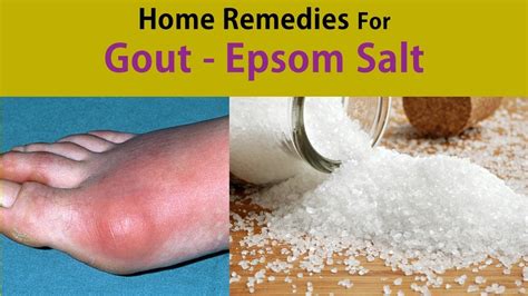 Home Remedies For Gout Stop Gout With Epsom Salt Youtube