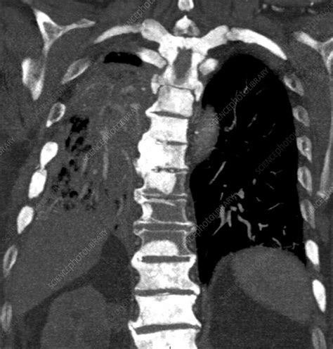 Bone cancer is a fairly rare disease, so if you've developed bone pain, don't jump to conclusions. Metastatic breast cancer, CT scan - Stock Image - C039 ...