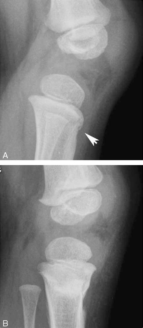 Figure 2 From Trampoline Fracture Of The Proximal Tibia In Children