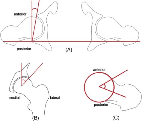 Traditional 2d Hip Angle Measurements A Anteversion Av Angle In The