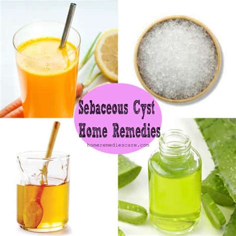 10 Easy Home Remedies For Sebaceous Cyst Removal Naturally