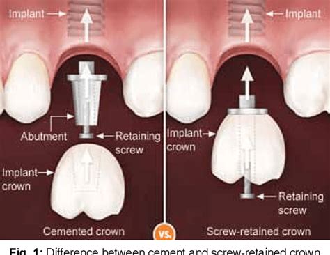 My Dental Implant Crown Keeps Coming Loose Afterva Oral Health Library