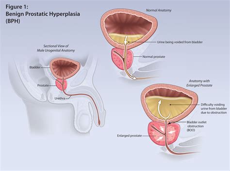 Benign Prostatic Hyperplasiamedical And Surgical Treatment Options