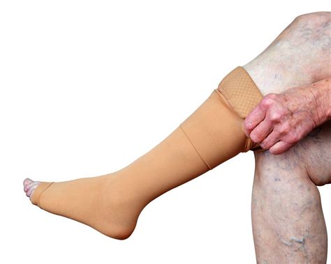 A Woman Puts A Compression Stocking On Her Leg With Varicose Veins Varicose Veins Prevention