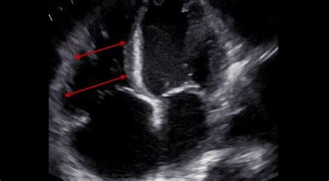 Right Heart Quantification Rv And Ra Size No Cme