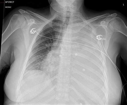 Complete White Out Massive Pleural Effusion Radiology Case