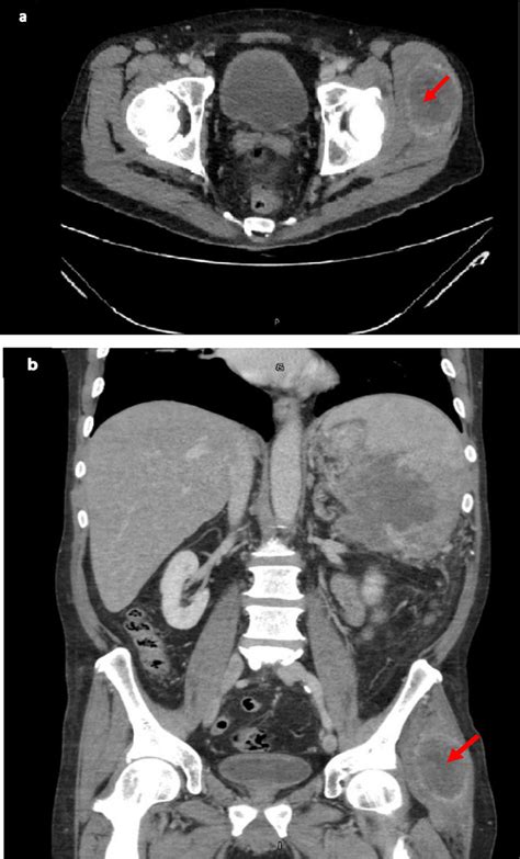 Ct Abdomen And Pelvis With Contrast Demonstrating A Heterogeneous