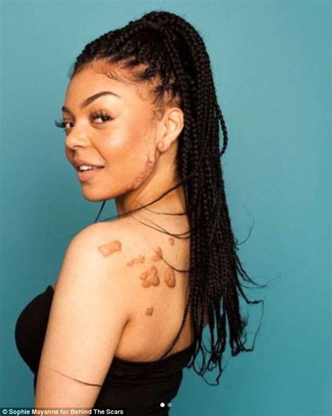 Bianca Lawrence Proudly Shows Off Her Keloid Scars In Viral Photos
