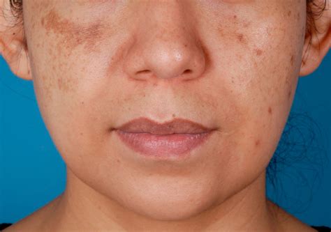 The Truth About Freckles Difference Between Melasma And Hyperpigmentation