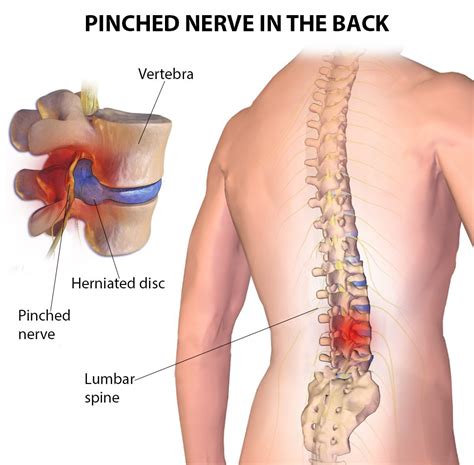 Pinched Nerves Specialists In Nyc New York Pain Care