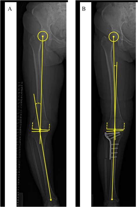 Comparison Of Torsional Changes In The Tibia Following A Lateral Closed