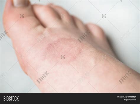 Human Leg Granuloma Image And Photo Free Trial Bigstock