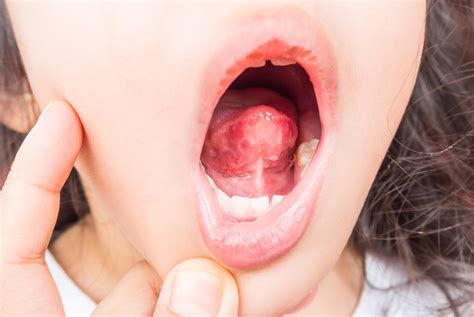 Tongue Disease Health Clues Hiding On Your Tongue Reader S Digest