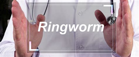 What Do I Need To Know About Ringworm