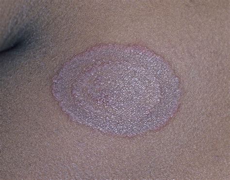 Ringworm Top 10 Most Contagious Illnesses Pictures Pics Express