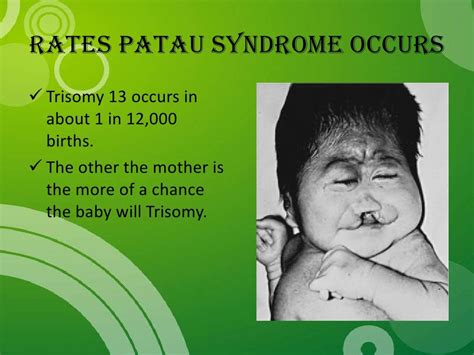 Patau Syndrome