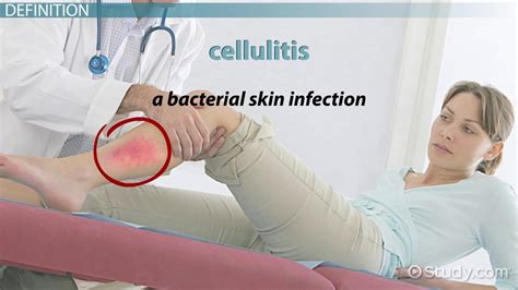 What Is Cellulitis Definition Causes Symptoms And Treatment Video