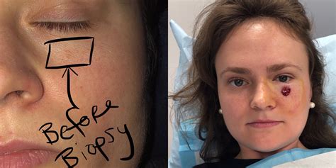 Woman 24 Thought Spot Under Eye Was A Pimple — It Turned Out To Be