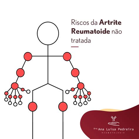 Riscos Da Artrite Reumatoide Não Tratada Artrite Reumatoide
