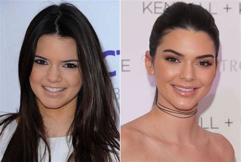 Kendal Jenner Plastic Surgery Before And After Photos