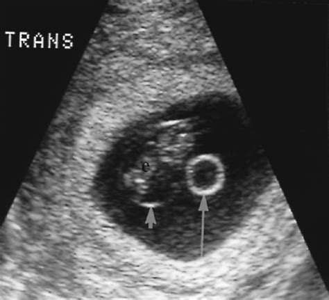 Obstetric Ultrasound First Trimester Radiology Key