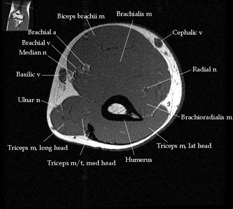 Anatomy of the knee is complex, through the use of magnetic resonance imaging, clinicians can diagnose ligament and meniscal injuries along with identifying cartilage defects, bone fractures and bruises. MRI Elbow Anatomy