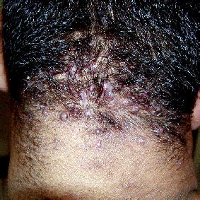 Acne Cheloidea della nuca - Società Italiana di Tricologia