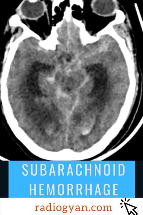 Subarachnoid Hemorrhage Radiology Case Subarachnoid