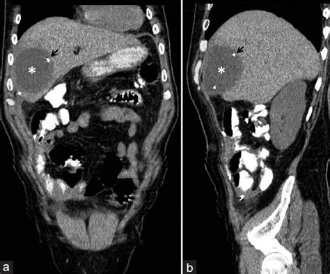 A Abdominal Ct Scans With Oral Contrast Demonstrates An Intrahepatic