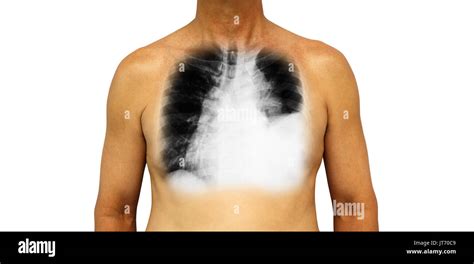 Lung Cancer Human Chest And X Ray Show Pleural Effusion Left Lung Due
