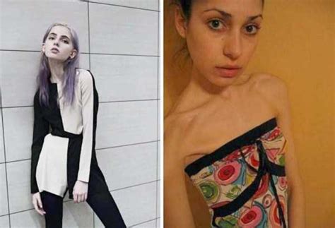 30 Shocking Pics Of Anorexic Girls Klyker