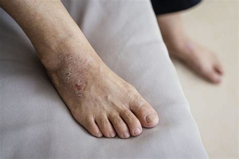 Feet Eczema Treatment Triggers And Lifestyle Changes