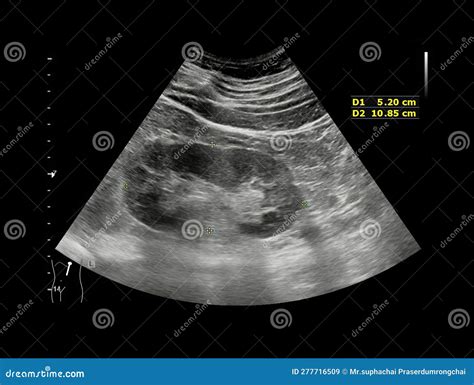 Ultrasound Of Kidney Or Kub For Screening Renal Stone Disease Or