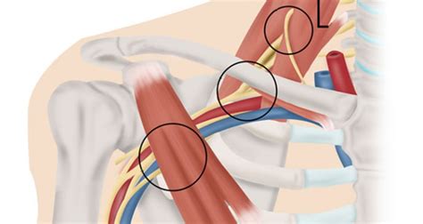 Thoracic Outlet Syndrome Symptoms Causes Treatment And Exercises