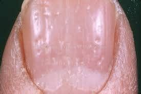 Pele espessada e seca com escamas e placas, lesões, bolhas, inchaço (mãos e pés inchados). PSORÍASE: Sintomas, Tipos e Tratamento ⋆ Orientação Médica ...