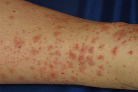 Purpura Schönlein Henoch Deximed Deutsche Experteninformation Medizin