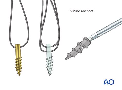 A mallet is used to introduce the. Suture anchors for Extraarticular fracture, avulsion of ...