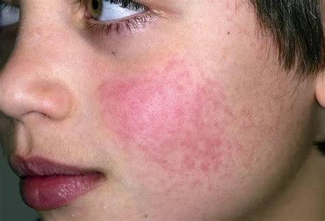 Erythema Infectiosum Picture Image On