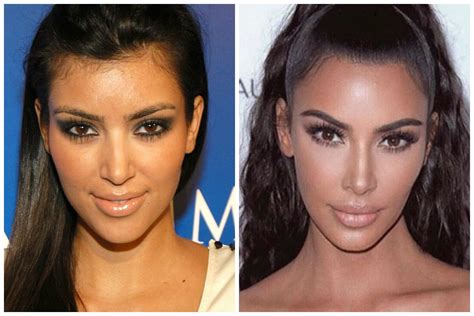 Kim Kardashian Face Pics Plastic Surgery Before And A