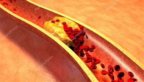 Clogged Artery With Platelets And Cholesterol Plaque — Stock Photo