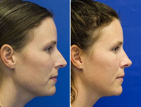 Long Over Projected Nose Rhinoplasty In Seattle Rhinoplasty Surgeon
