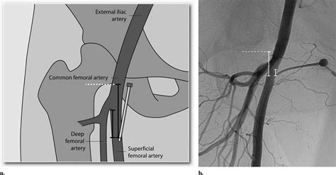 Antegrade Access To The Superficial Femoral Artery With Ultrasound