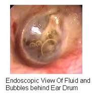 A lot of times they'll start tugging or pulling on an ear. Adult middle ear infection | XXX Porn Library