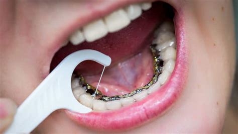 Lingual Braces Miami Orthodontics Specialists Of Florida