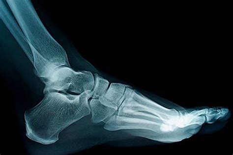 Ankle Arthritis Latest Technologies For Treatment Of Ankle Arthritis